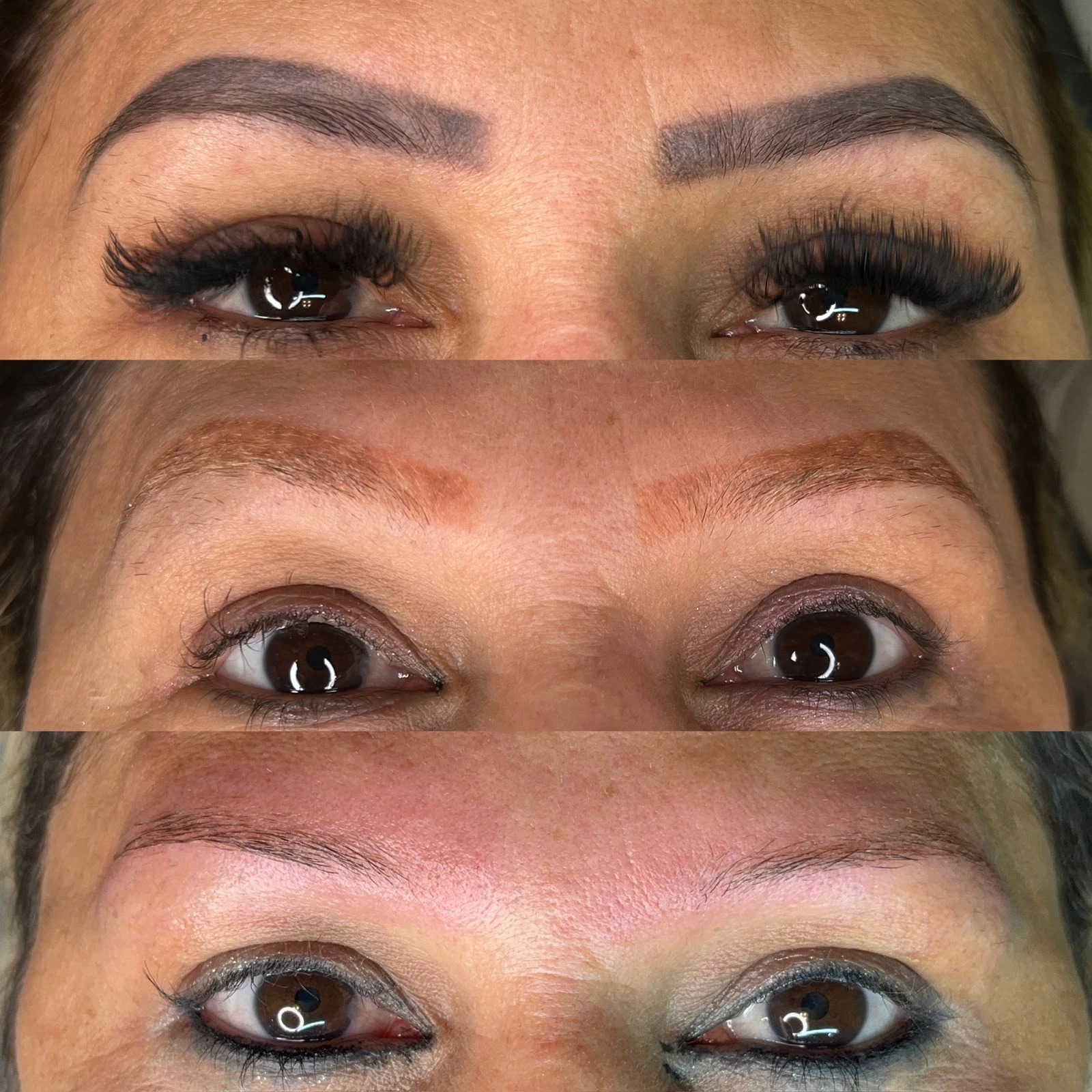 Remoção a Laser Antes e Depois 2